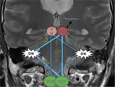 Multicenter Prospective Analysis of Hypertrophic Olivary Degeneration Following Infratentorial Stroke (HOD-IS): Evaluation of Disease Epidemiology, Clinical Presentation, and MR-Imaging Aspects